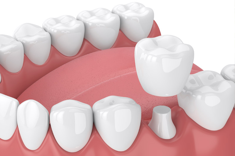 Dental Crowns in American Fork