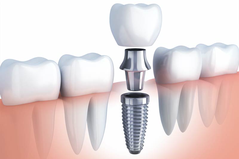 Implants Dentist in American Fork