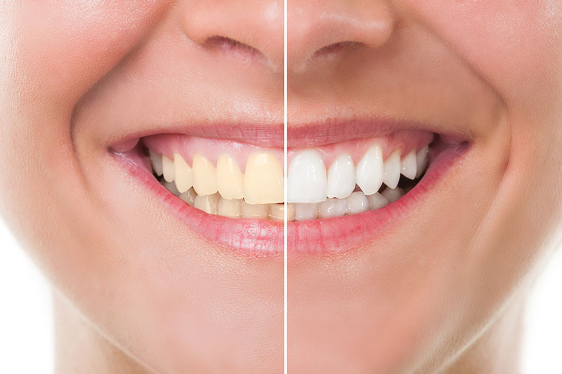 Teeth Whitening in American Fork